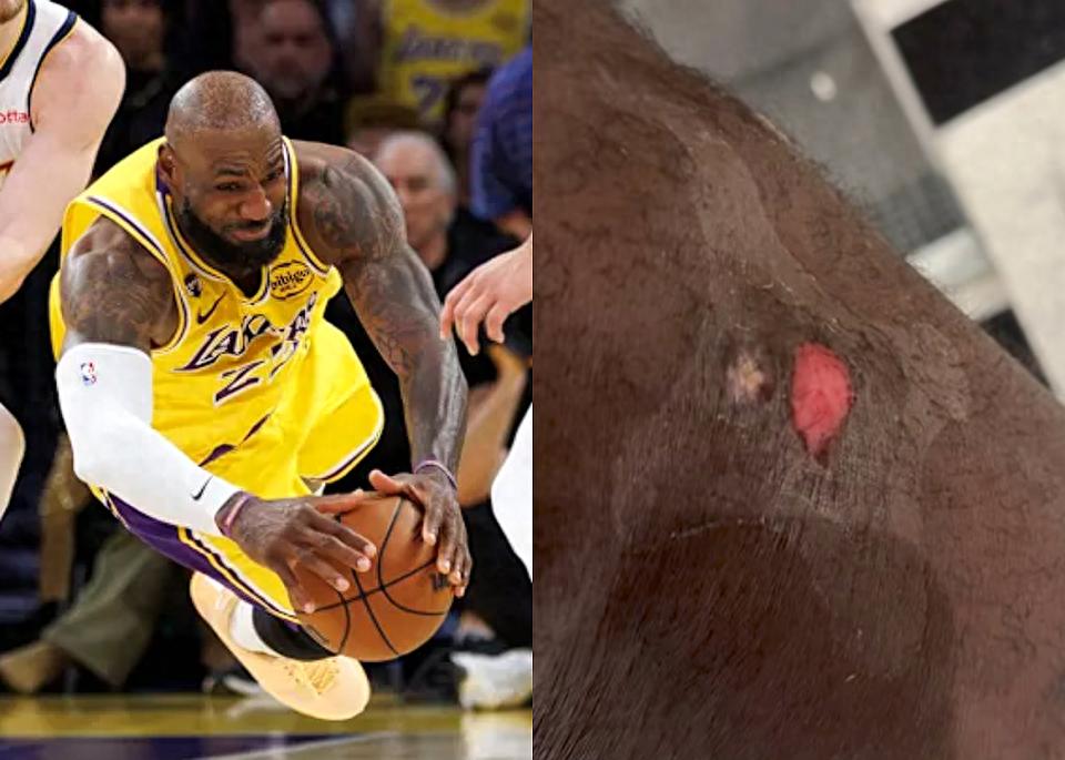 调侃今年救球到此为止！詹姆斯展示伤口感叹疼痛 恭喜东契奇获选周最佳